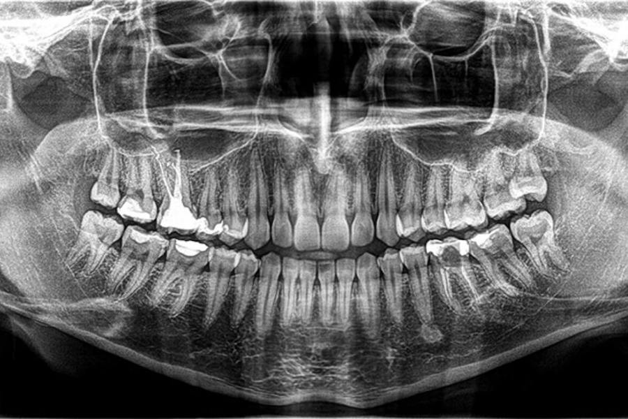 Ortopan CBCT (3D i 2D)